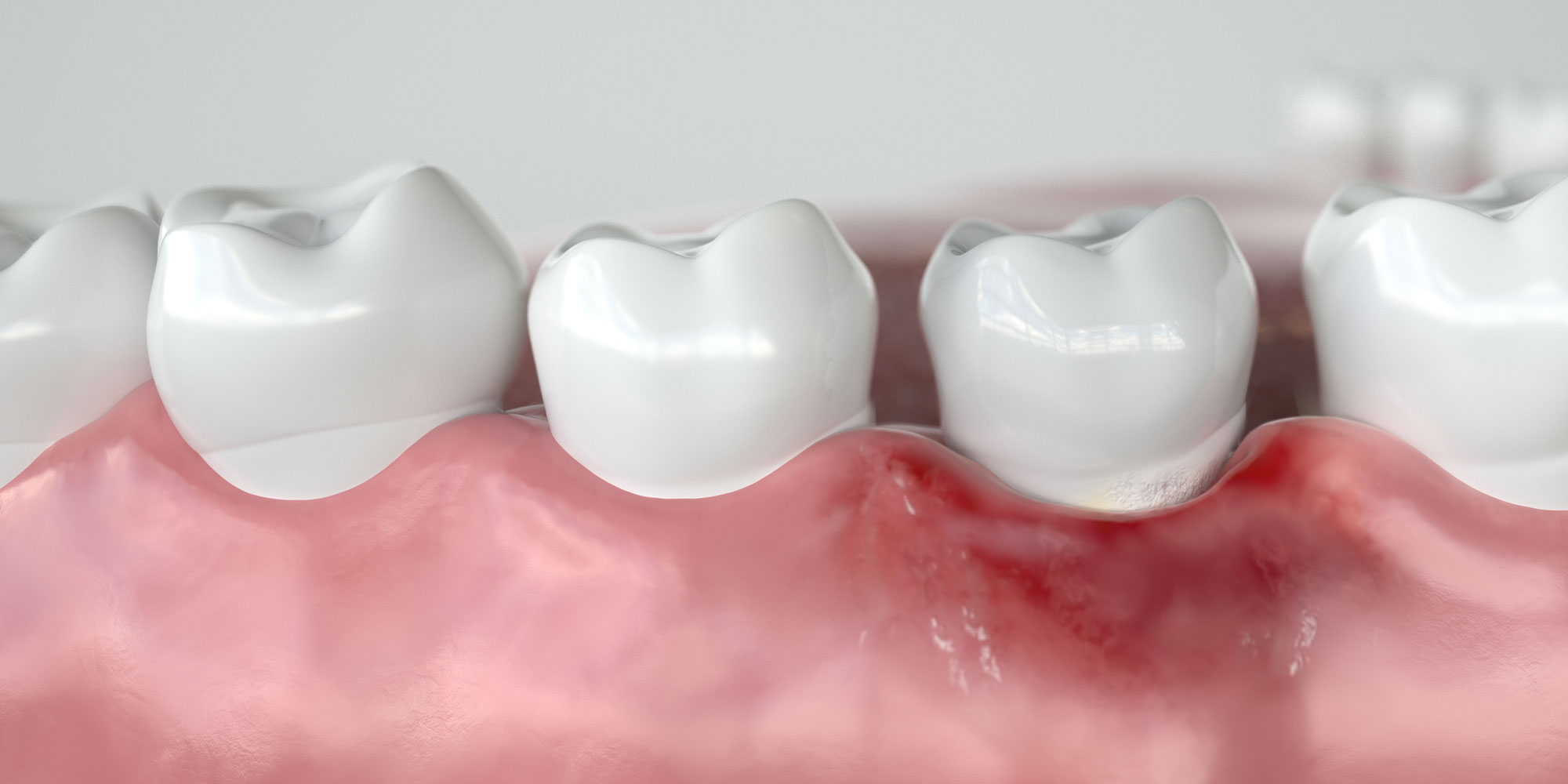 periodontist hoover al gum disease