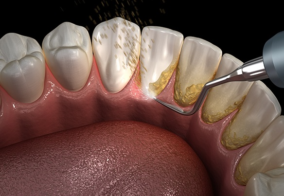 periodontal-maintenance-hoover-al