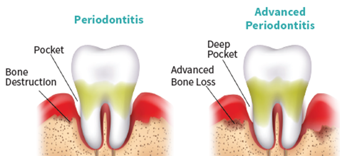 periodontis-diagnosis-dentist-hoover-al