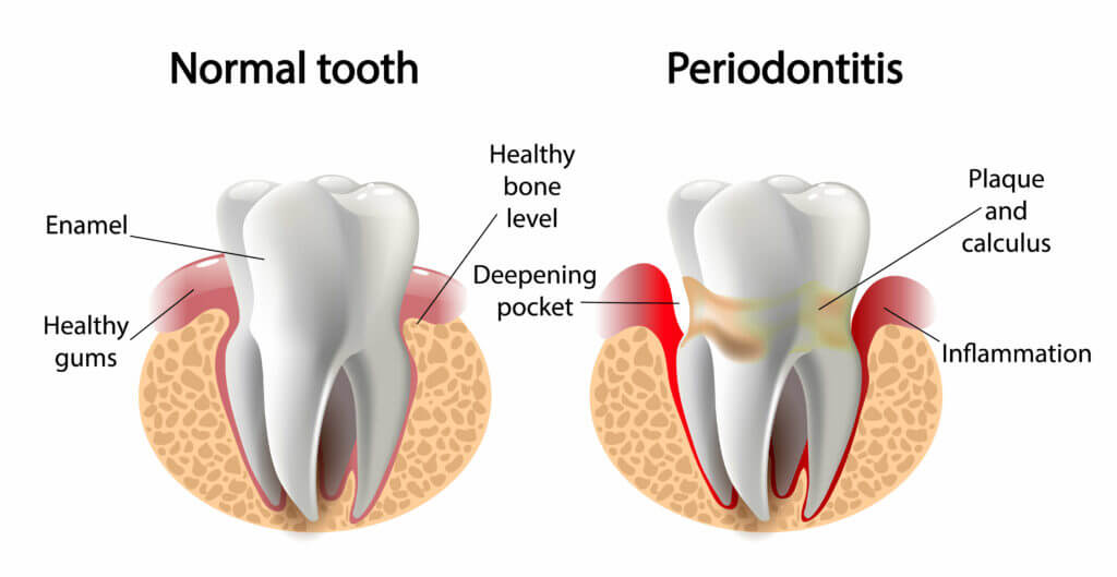 periodontis-diagnosis-hoover-al