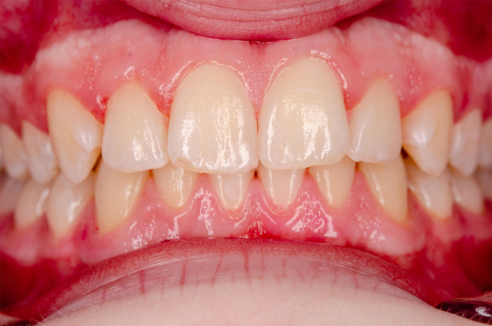 periodontitis-dentist-hoover-al