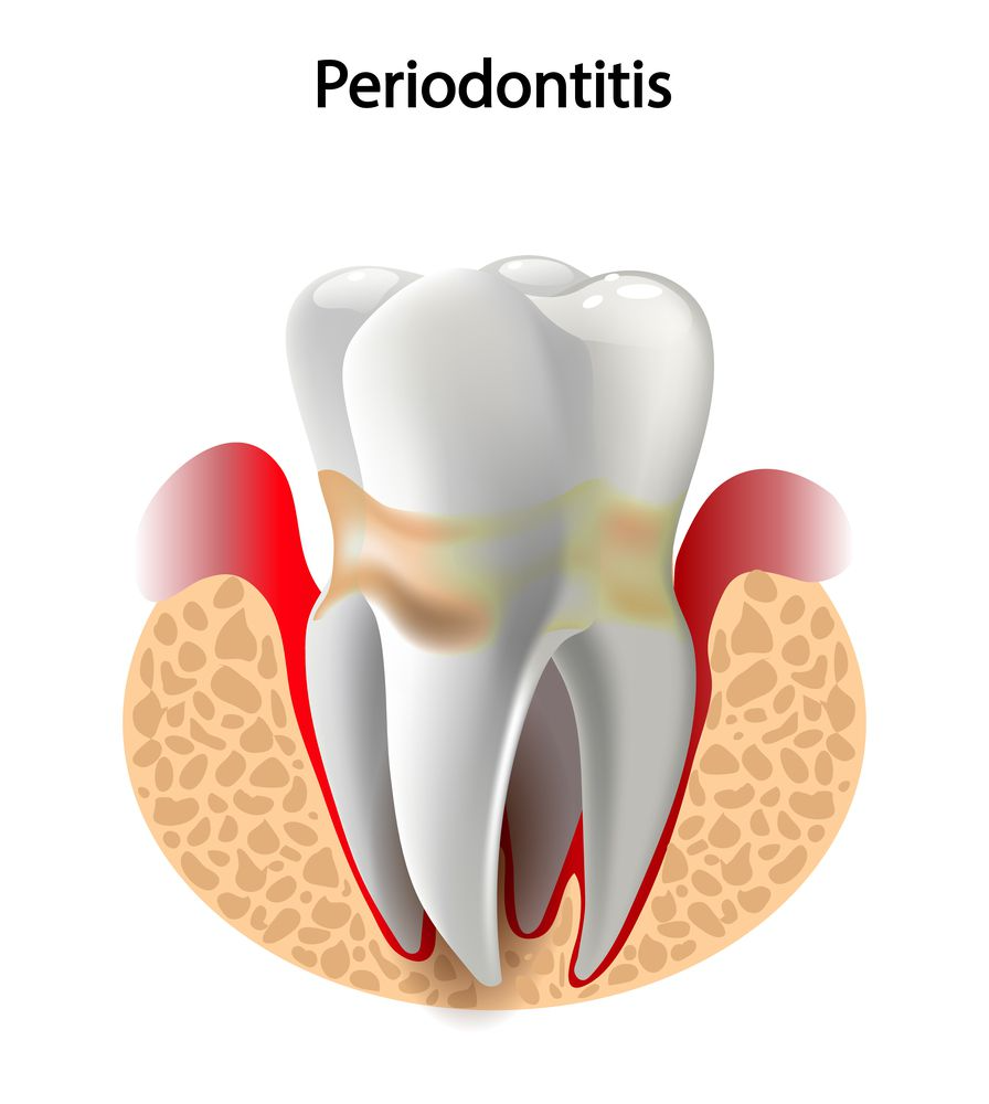 periodontitis-hoover-al