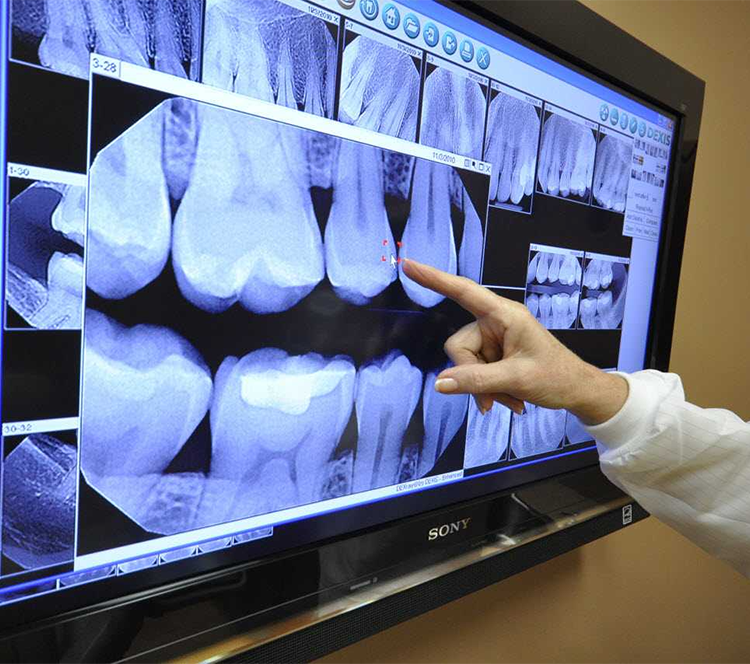 teeth-digital-x-ray-dentist-hoover-al