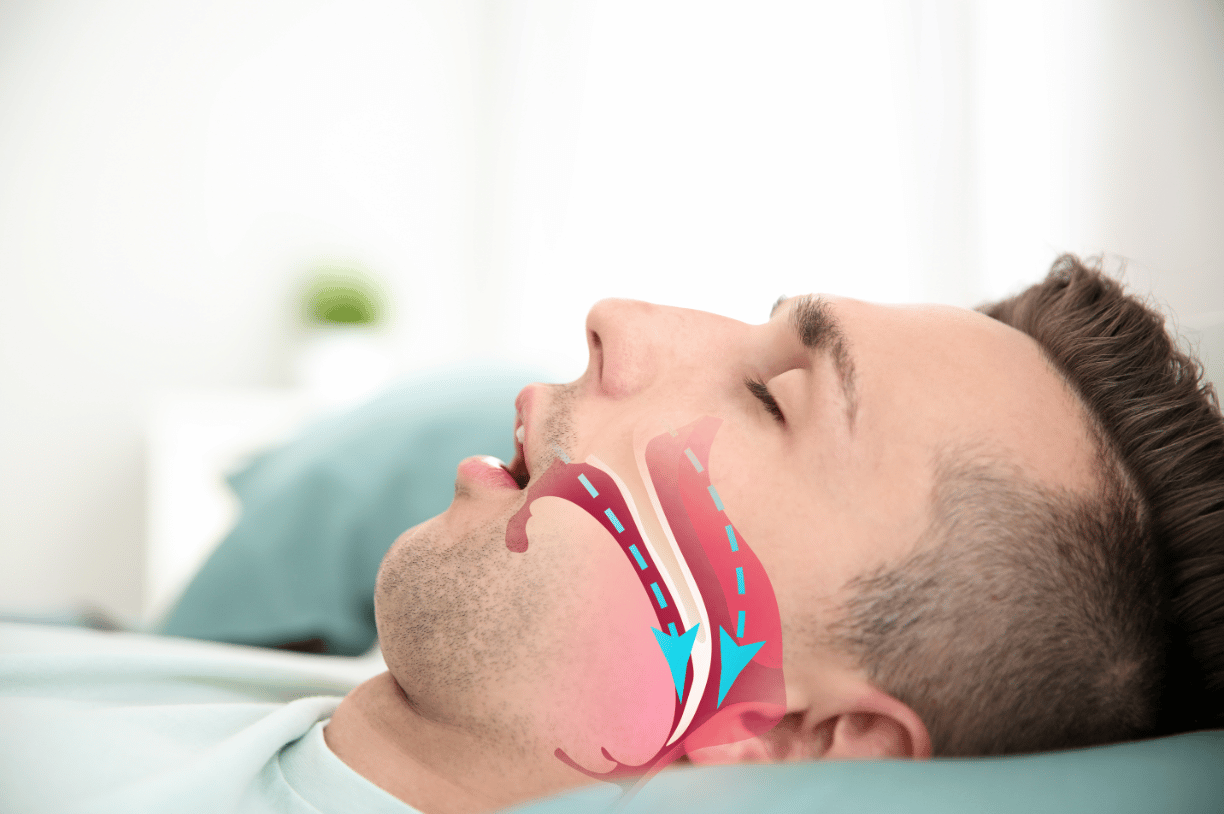 sleep apnea hoover al treatment