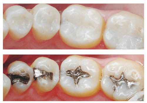 amalgam filling vs composite filling dentist hoover al