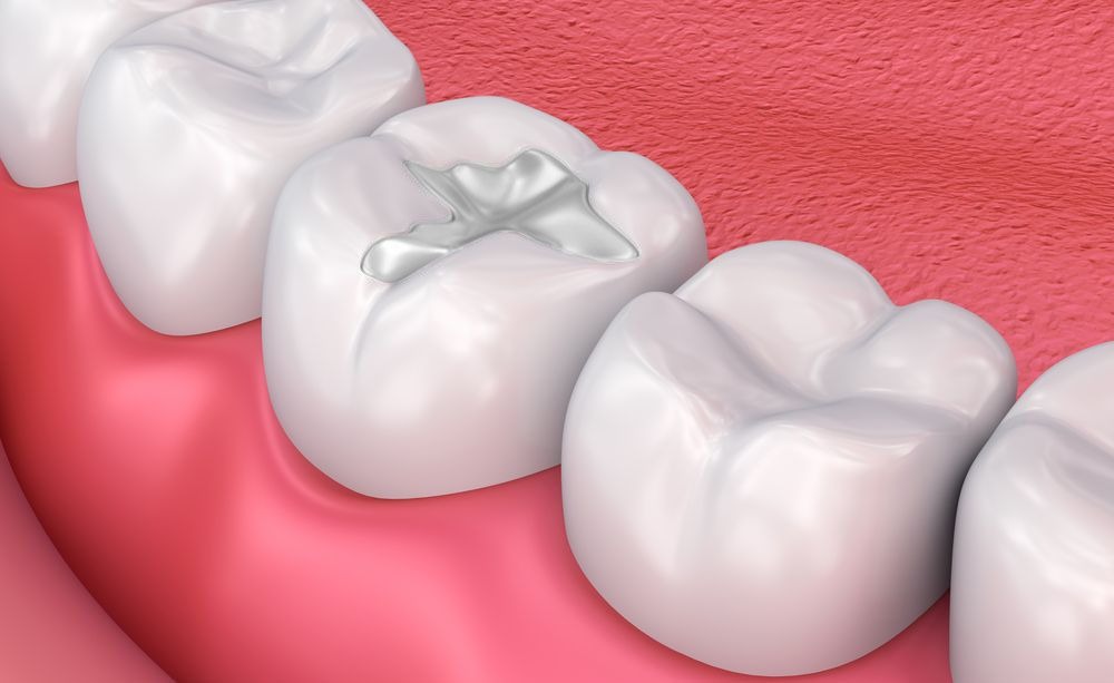 animated composite fillings