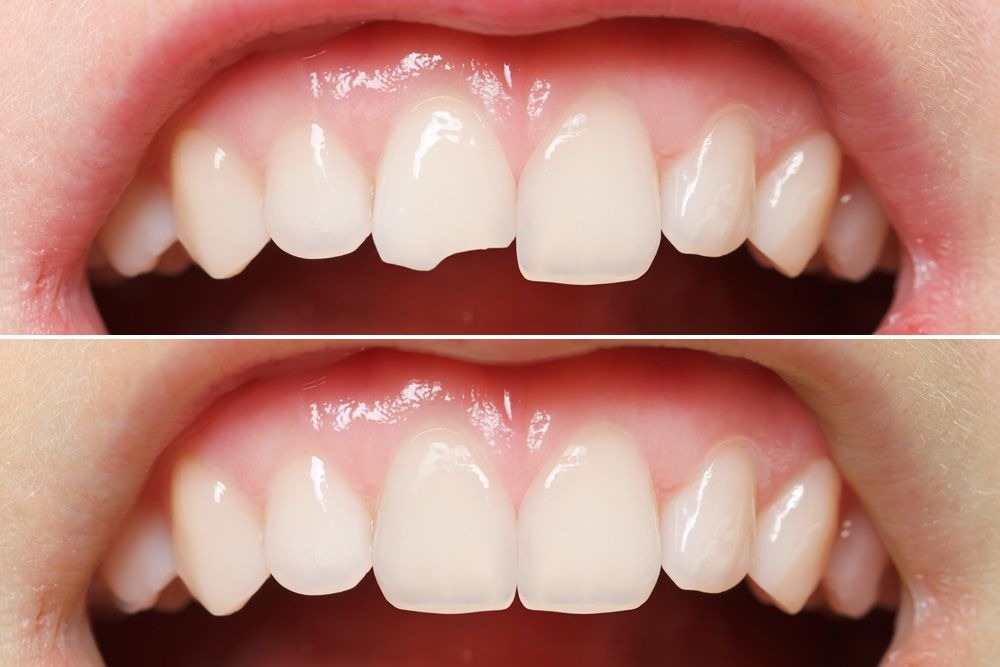 Before & After, Cracked Tooth Repair Images