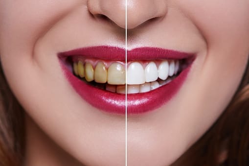 before and after of dental veneers in bessemer al