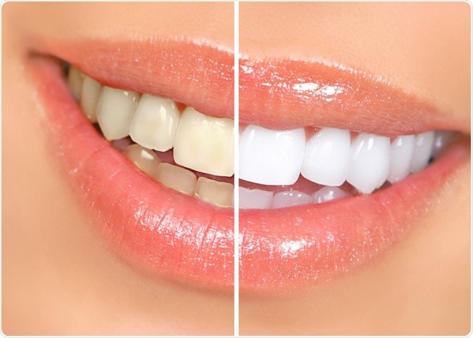 before and after teeth whitening hoover and bessemer