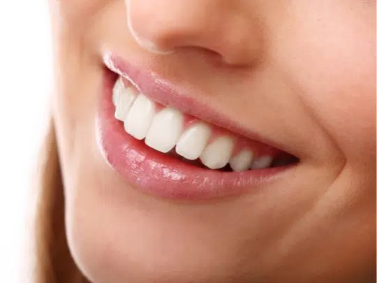 big smile after veneers and cosmetic dentisry in hoover al