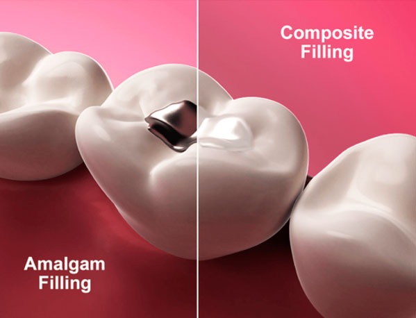 comparison of amalgam filling vs composite filling