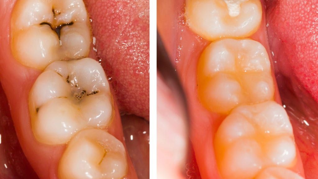 thumbnail image 2 of Dental Amalgam Acorn & Westcott Burnishers Set – Composite Filling Instruments (Stainless Steel) 2 of 3
