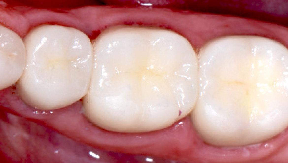 composite fillings in teeth hoover al