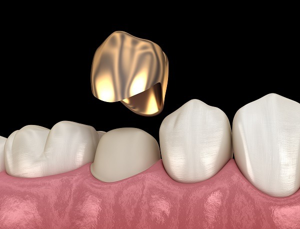 dental crown dental procedure in hoover al