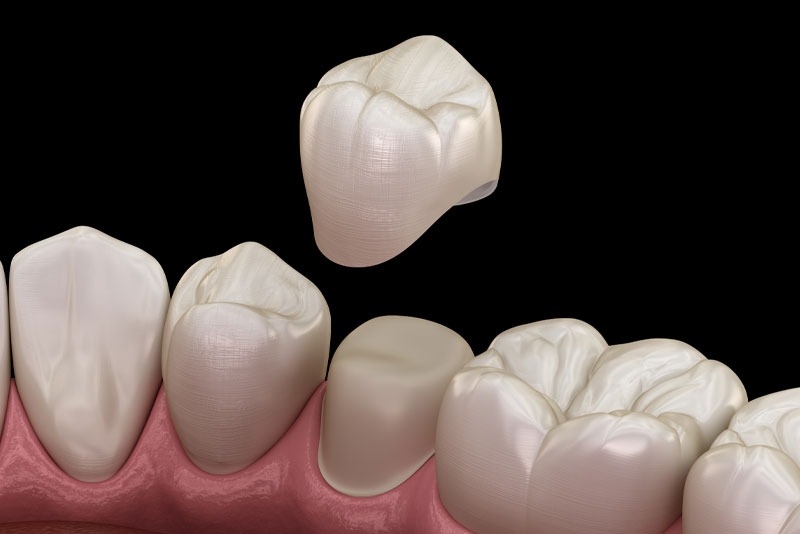 dental crown in bessmer al expert dentist