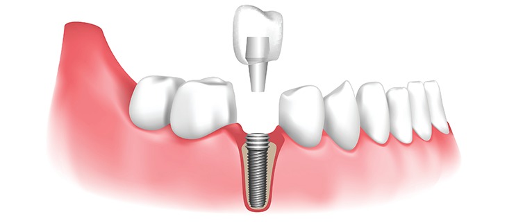 dental implant procedure hoover al