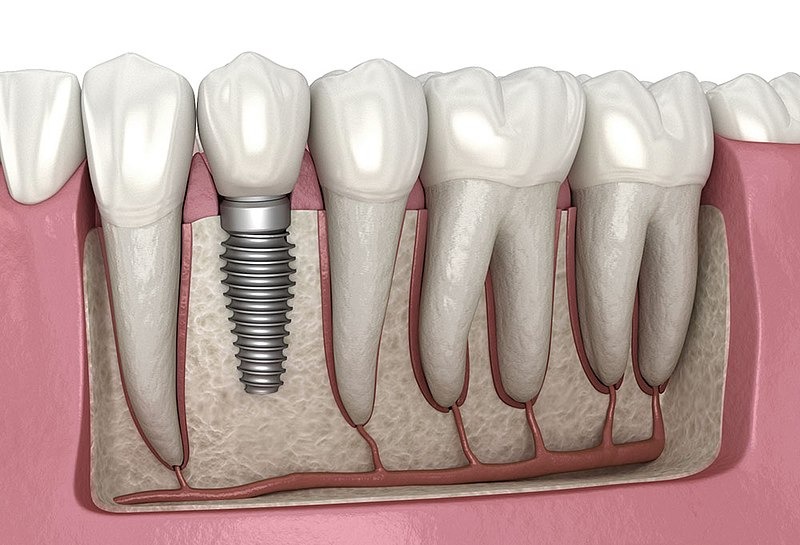 dental implants hoover al