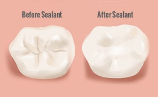 dental sealant before and after picture hoover al and bessemer al