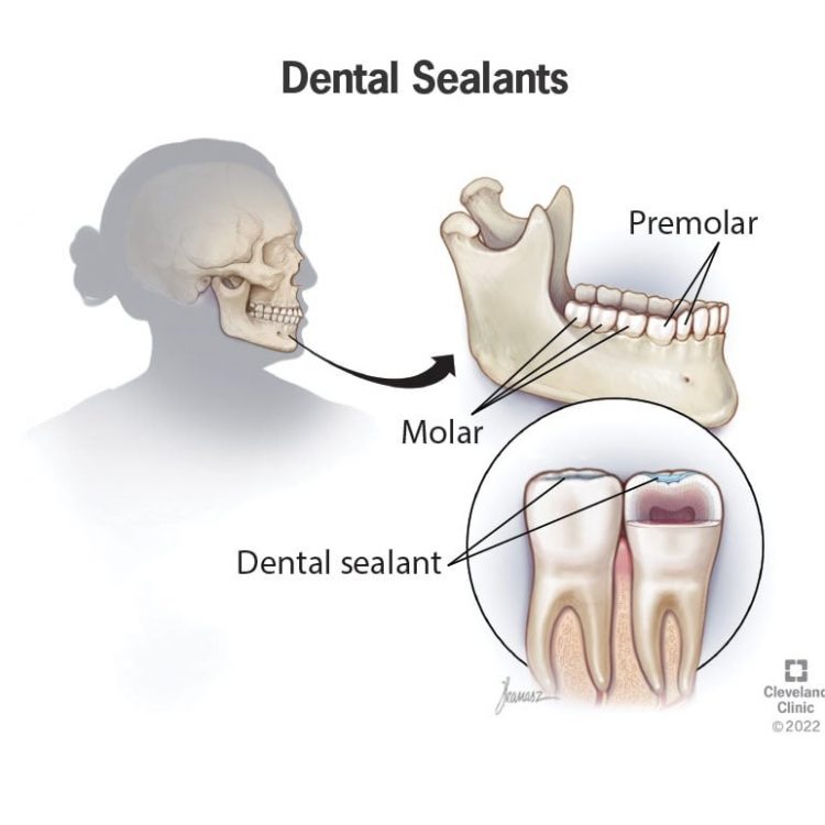 dental sealant example diagram in hoover al and bessemer al