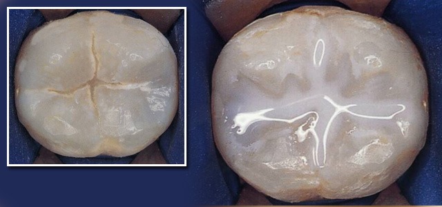 example of a dental sealant in hoover al and bessemer al
