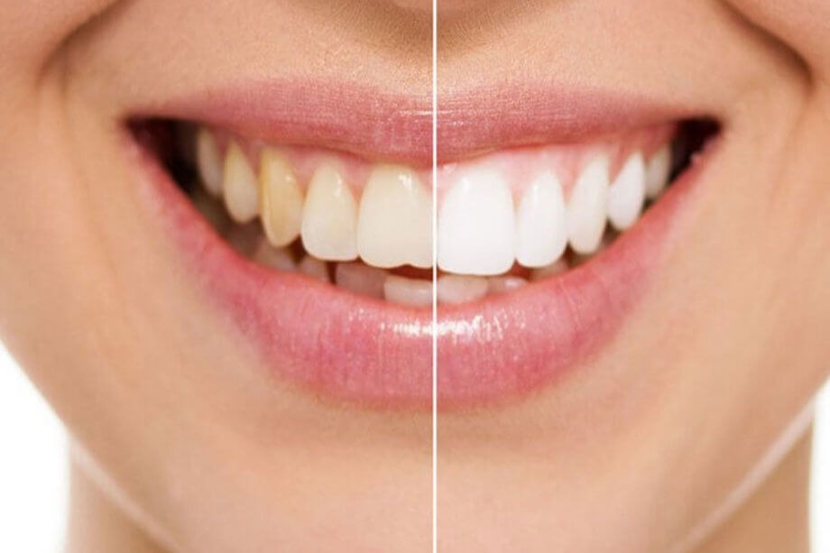 happy before and after teeth whitening patient hoover al