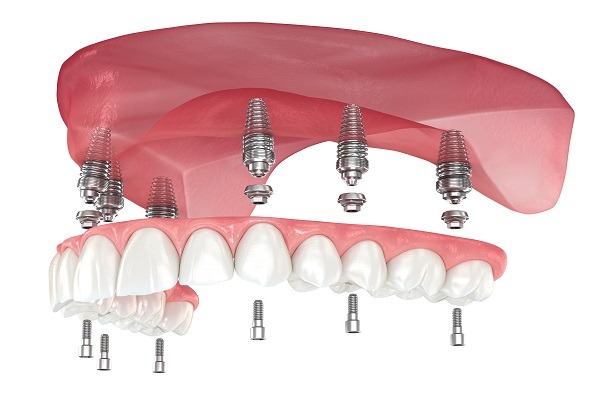 implant supported dentures in hoover al
