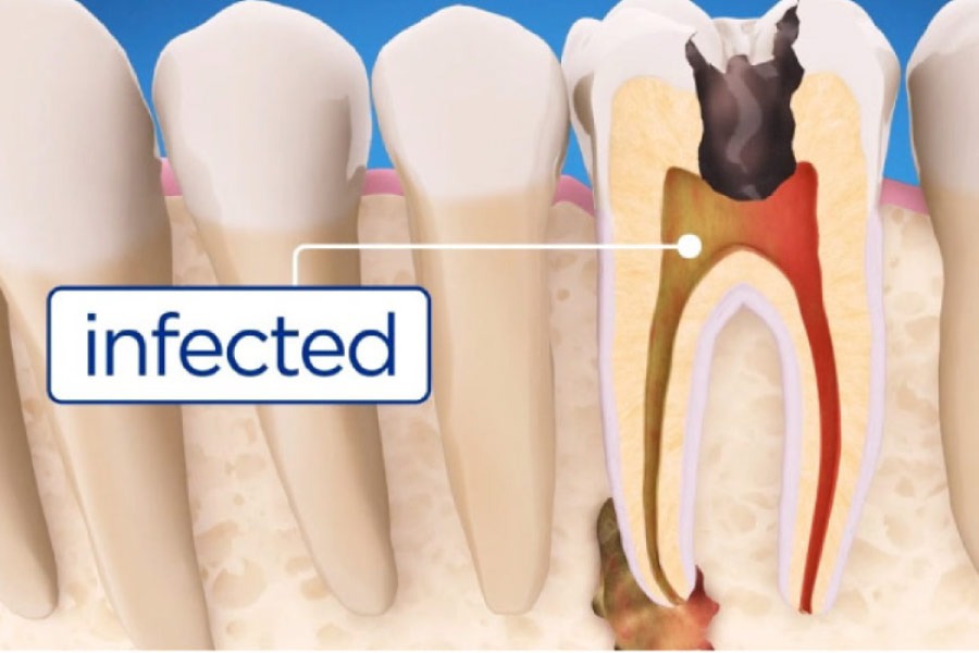 infected root canal in hoover al