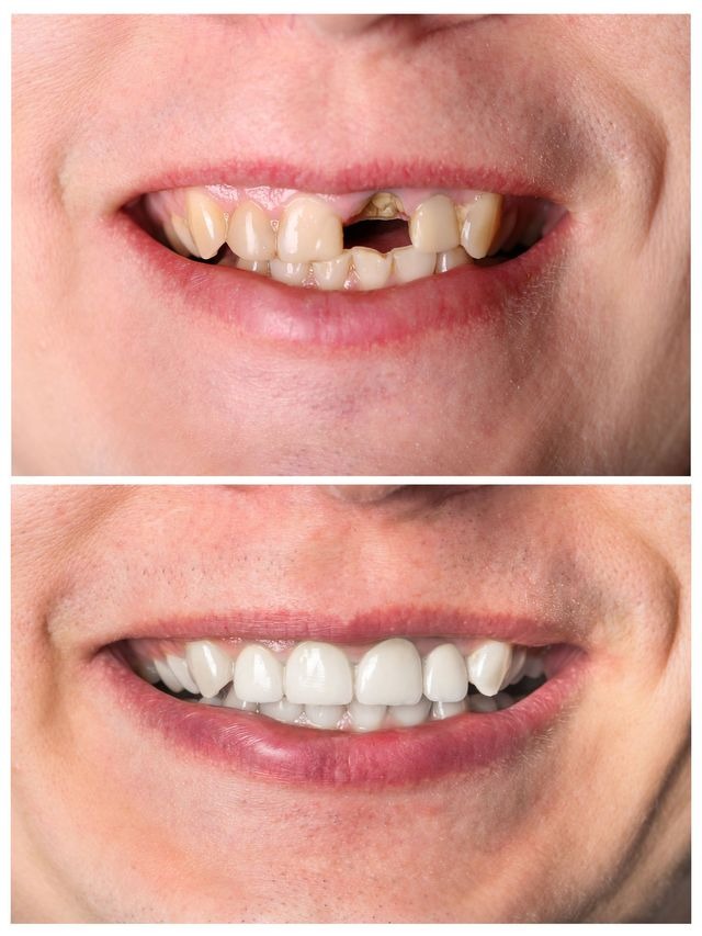missing tooth fixed with dental crown in hoover al