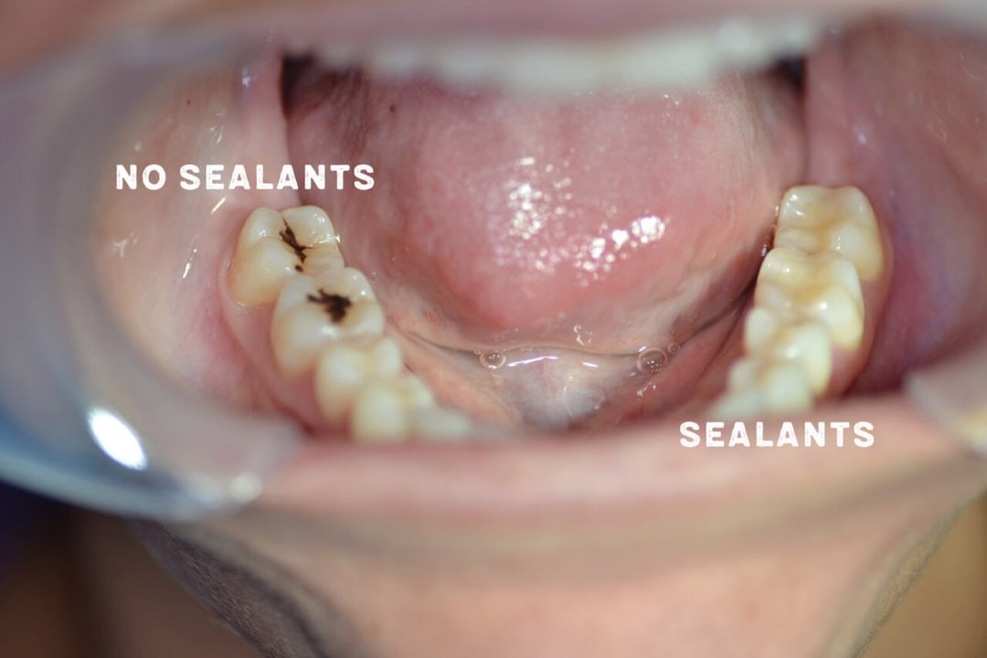 no sealants vs sealants