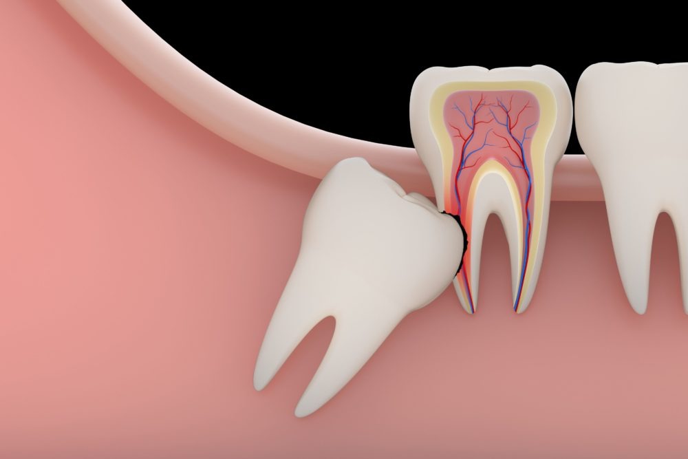 painful tooth in hoover al and tooth extraction solutions