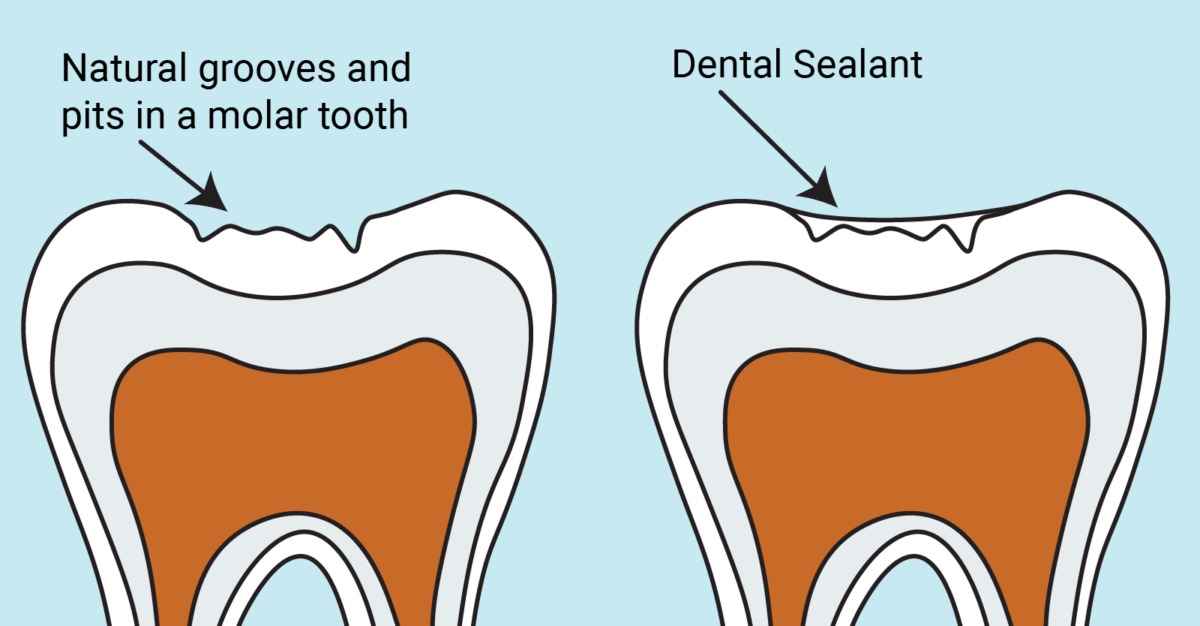 pits in a molar vs dental sealants in hoover al