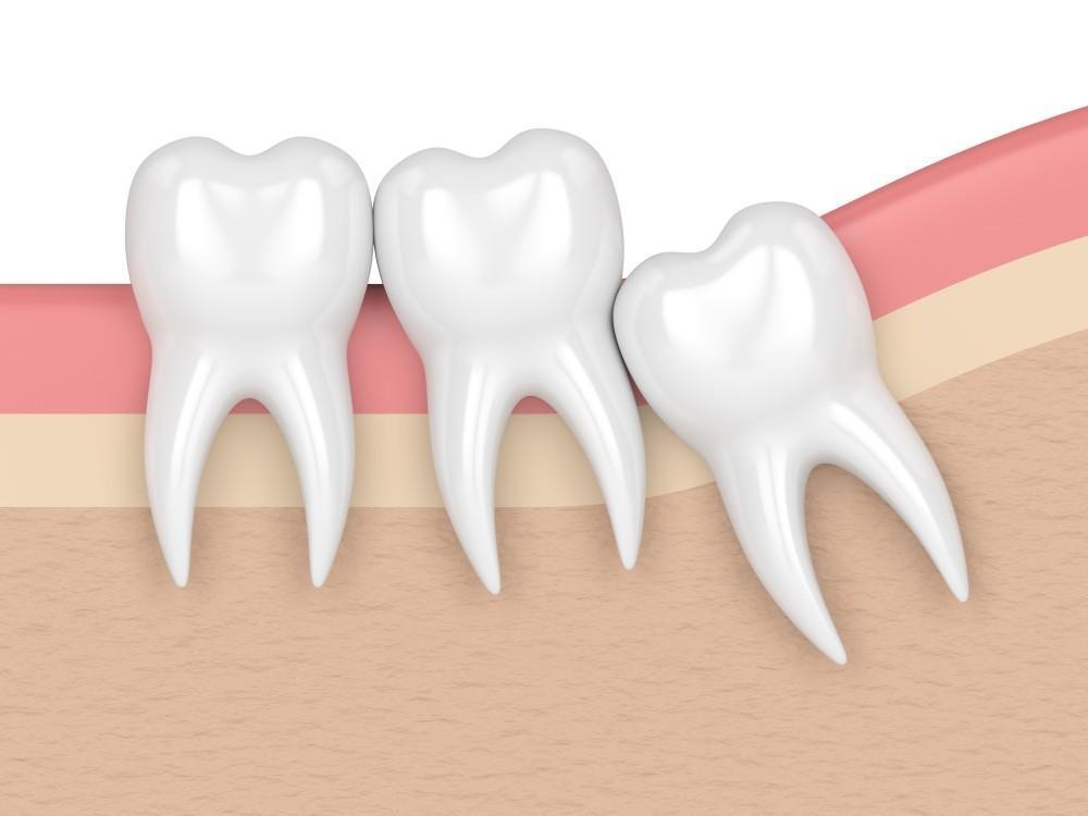 signs you need a tooth extraction in hoover al