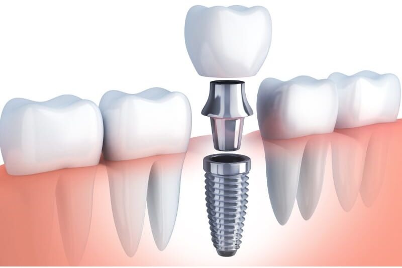 structure of dental implant bessemer al