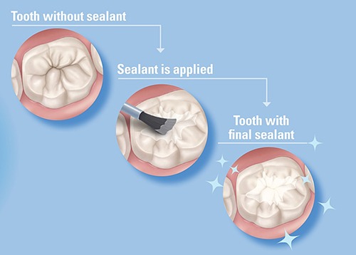 tooth with dental sealant in hoover al and bessmer al