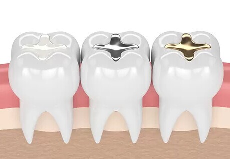 types of composite fillings