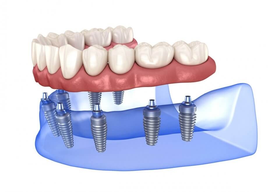 types of dental implants hoover al